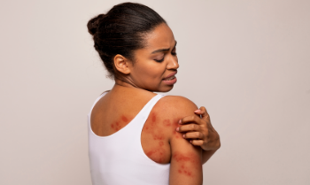 Top 10 Atopic Dermatitis Itch Relief Medication Options